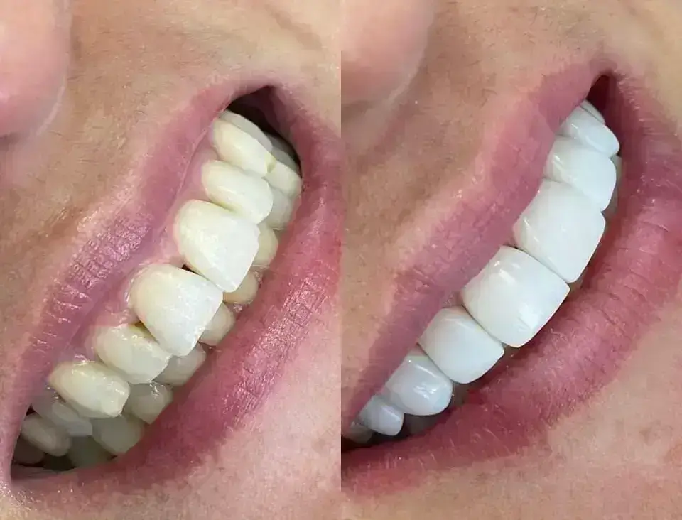 servicio Diseño de sonrisa en cerámica y resina de alta estética